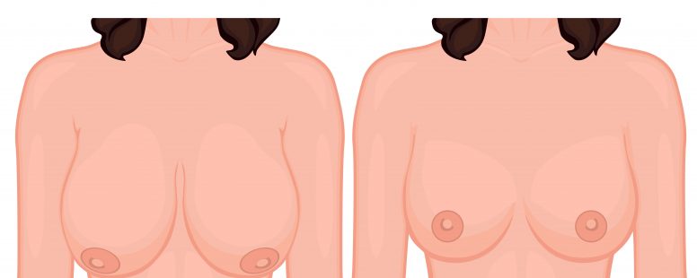 جراحی ماموپلاستی و لیپوساکشن برای کوچک کردن سینه زنان: آنچه باید بدانید!؟