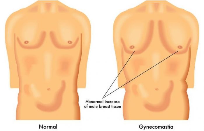 gynecomastia یا ژنیکوماستی یعنی بزرگ شدن سینه مردان