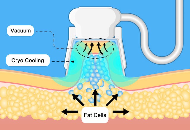 نحوه عملکرد کرایولیپولیز
