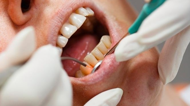 کاربرد لیزرهای بافت سخت در دندانپزشکی ترمیمی و زیبایی
