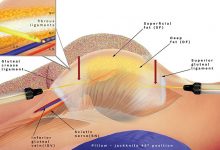 عمل تغییر و تجدید بزرگ کردن باسن با تزریق چربی چیست؟