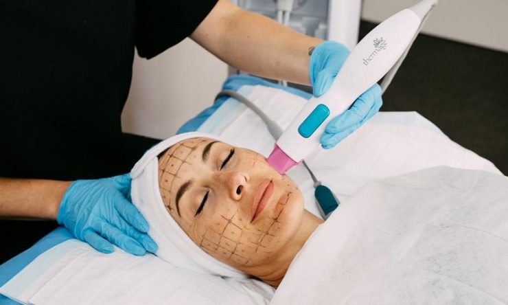 اثرات آر اف ترماژ برای جوانسازی پوست-آنچه باید بدانید!؟