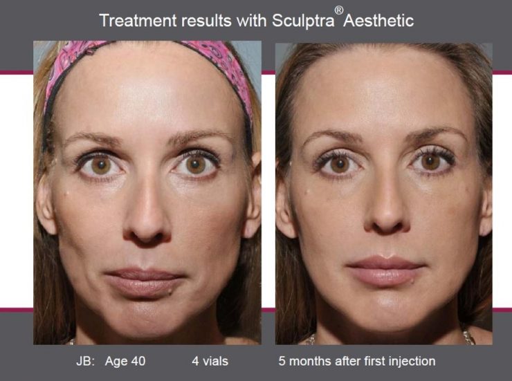 تزریق فیلر زیبایی اسکالپترا Sculptra چیست؟