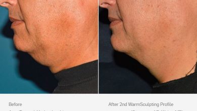 اسکالپشور غبغب برای درمان چربی آن مجوز FDA دریافت کرده است