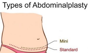 ابدومینوپلاستی مینی