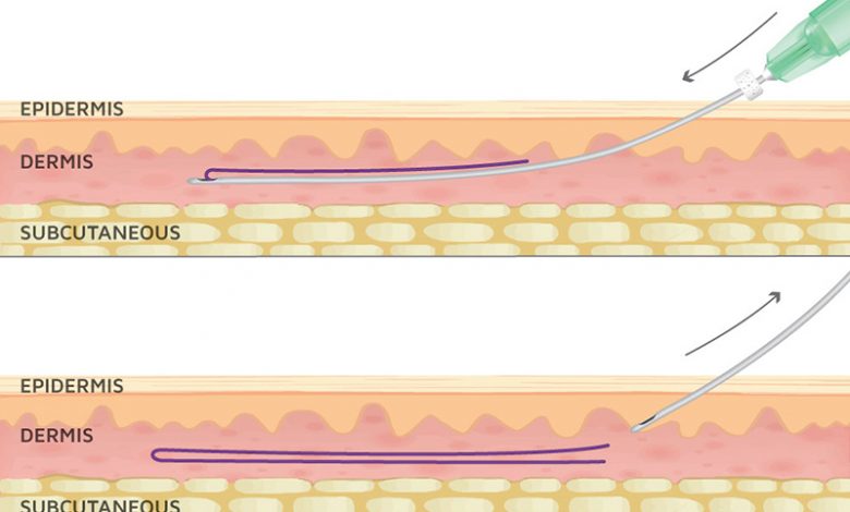 کاشت نخ بدن pdo برای کاهش سایز و لیفت پوست