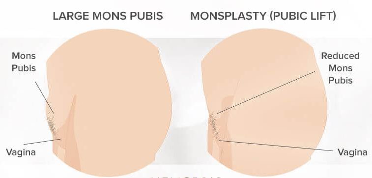 مزایا و معایب جراحی مونسپلاستی آلت تناسلی زنان چیست؟