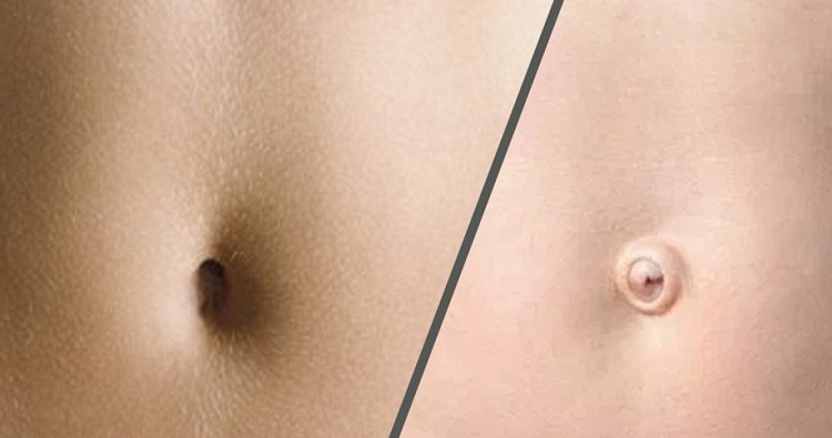جراحی ناف یا آمبیلیوپلاستی برای زیبایی، لیفتینگ و فتق ناف ⋆ کلینیک‌ها