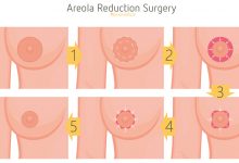 جراحی آرئول یا کاهش هاله سیاهی دور نوک سینه زنان و مردان