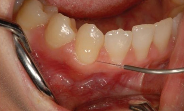 حساسیت زدایی دندان برای رفع حساسیت شدید با روش‌های مختلف