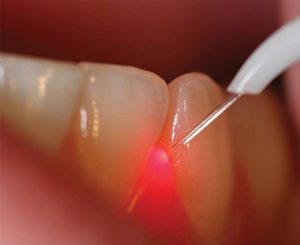 چرا درمان حساسیت دندان با لیزر بهتر است؟