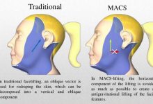 جراحی لیفت صورت ماکس MACS چیست؟مزایا و معایب
