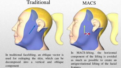 جراحی لیفت صورت ماکس MACS چیست؟مزایا و معایب