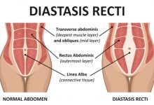 جراحی ترمیم دو تکه شدن عضله‌‌ی راست شکم: چیزهایی که باید بدانید