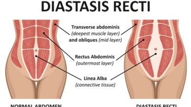 جراحی ترمیم دو تکه شدن عضله‌‌ی راست شکم: چیزهایی که باید بدانید