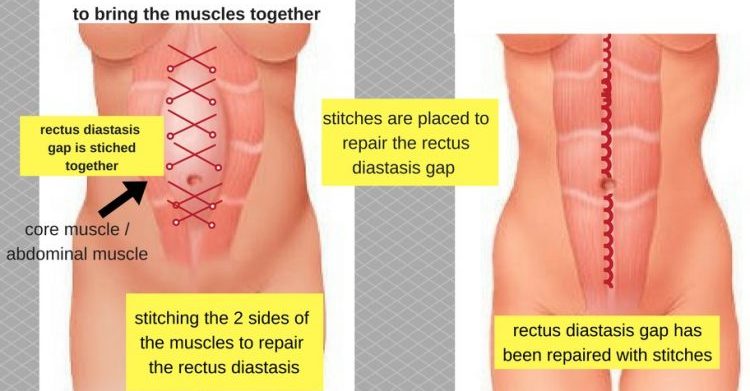 در طی جراحی جداشدگی عضله‌‌ی راست، چه اتفاقی می‌‌افتد؟